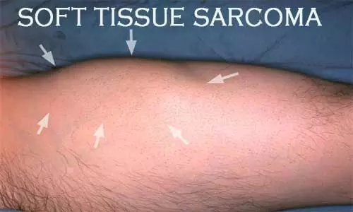 soft-tissue-sarcoma Problem