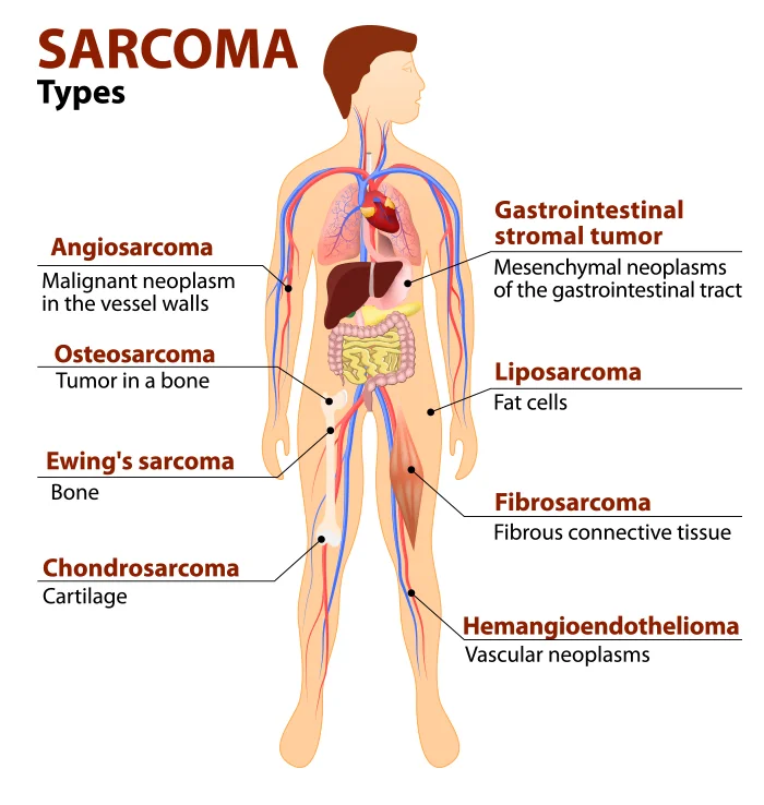 sarcoma Detail