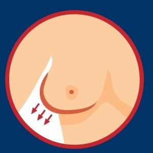 Change in breast size, shape