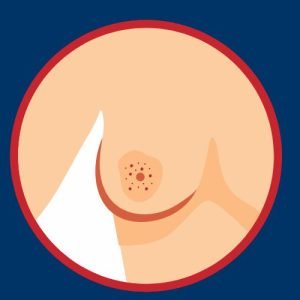 Nipple changes​