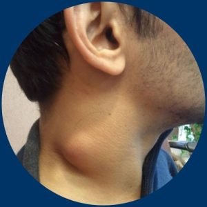 Swelling in the Neck