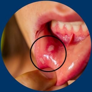 Mouth Sore