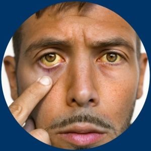 jaundice sign