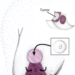 Level II Oncoplastic Surgery1