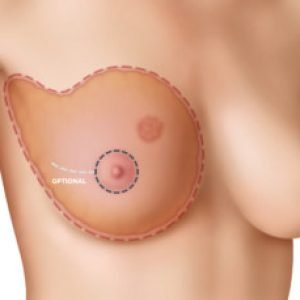 Nipple-Sparing or Skin-Sparing Approaches