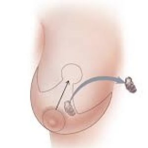 Oncoplastic Breast Conservation1