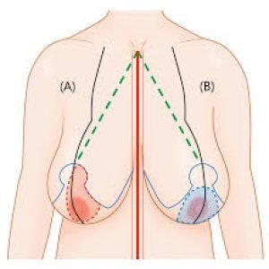 Reduction Mammoplasty Techniques