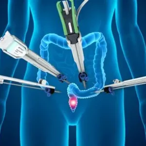 Robotic Colorectal Surgery