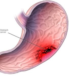 Robotic Gastroesophageal Junction