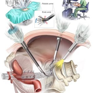 Robotic Hysterectomy