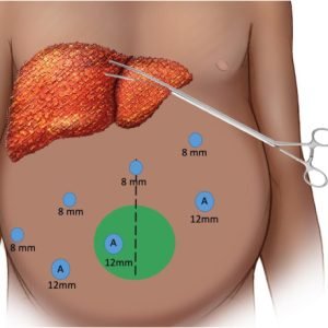 Robotic Liver Surgery