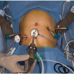 Robotic Ovarian Tumor Surgery