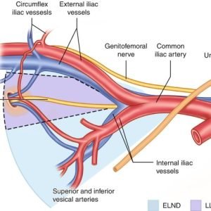 Robotic Pelvic Lymph Node Dissection