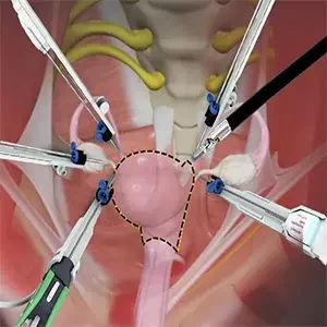Robotic Radical Hysterectomy