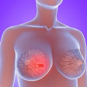 Standard Lumpectomy