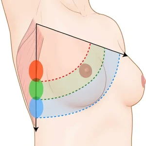 Volume Displacement Techniques