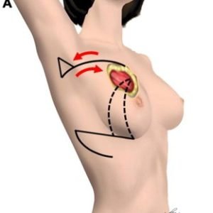 Volume Replacement Techniques1