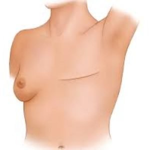 Volume Replacement Techniques12