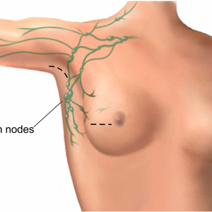 Wide Local Excision (WLE)