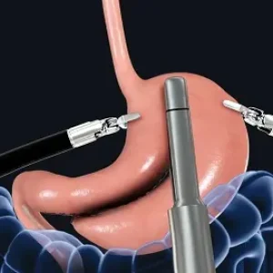 Robotic Gastric Surgery